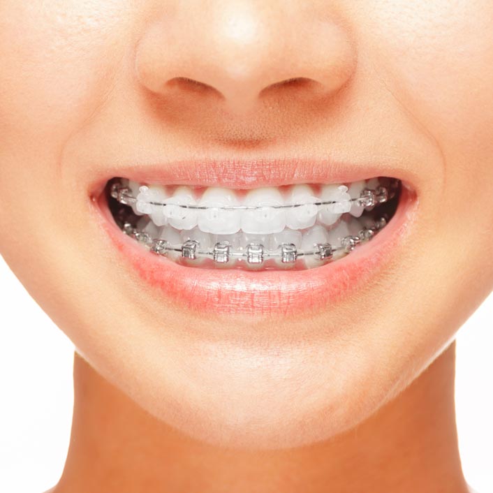 Orthodontic Treatments - Dental Services